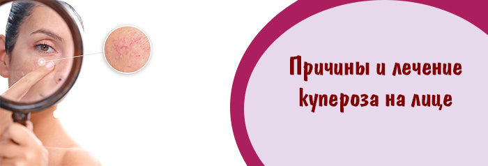 Причини і лікування купероза на обличчі в домашніх умовах: який крем вибрати