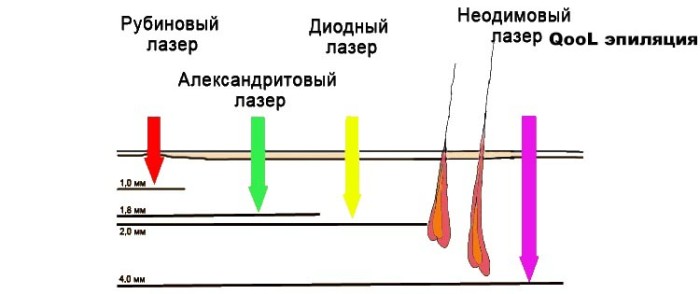 QOOL епіляція або лазерне видалення волосся